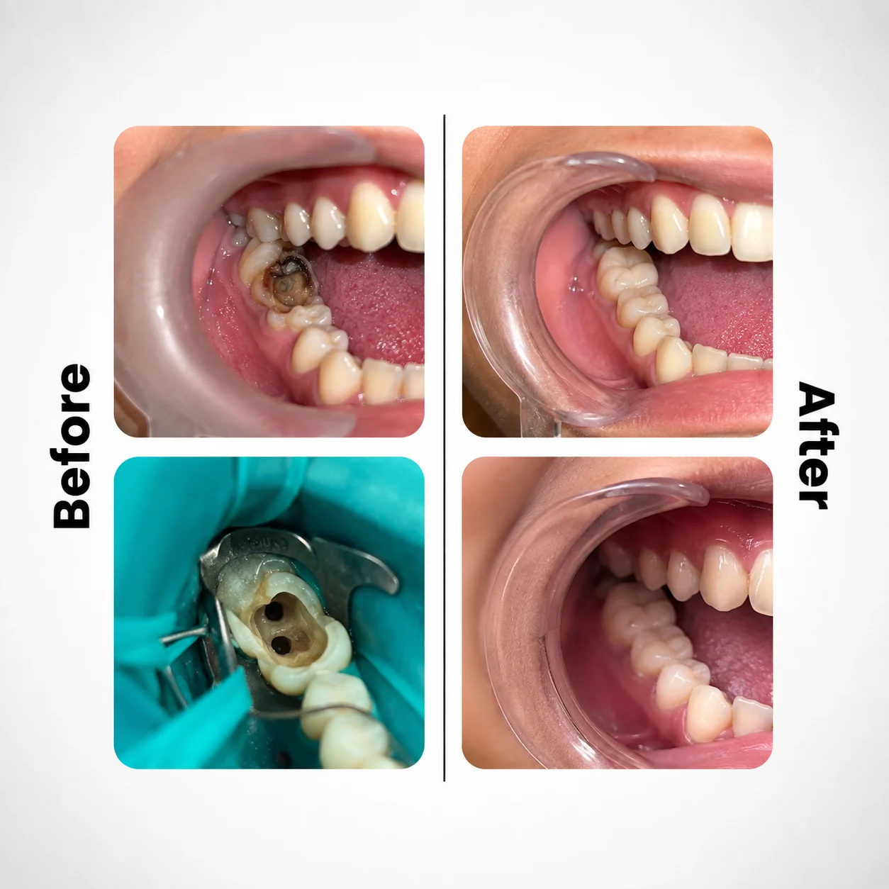 Root Canal Treatment