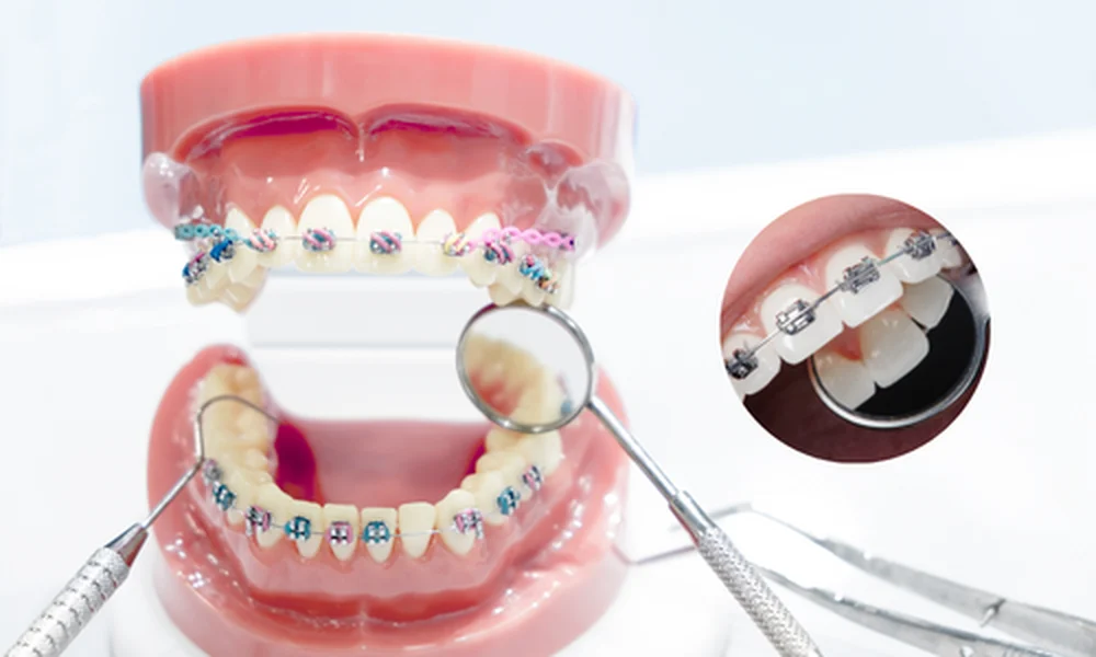 Root Canal