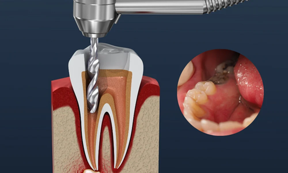 Root Canal