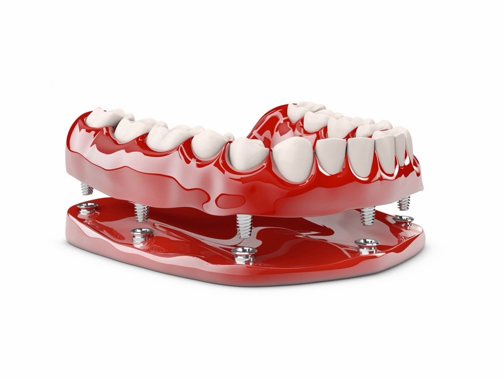 Root Canal