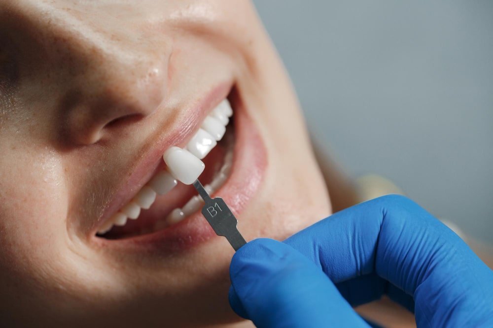 Root Canal